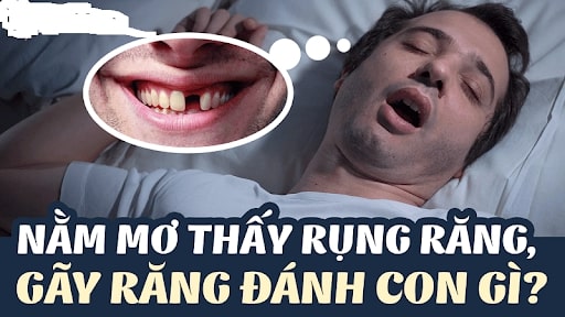 Nằm mơ thấy rụng, gãy răng là điềm gì?